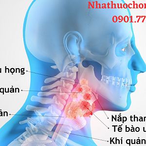 Ung thư thanh quản: Nguyên nhân, dấu hiệu và phương pháp điều trị?