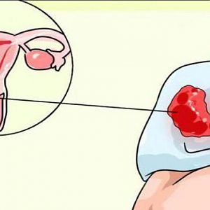 Dấu hiệu ung thư âm hộ là bệnh gì và cách phòng tránh